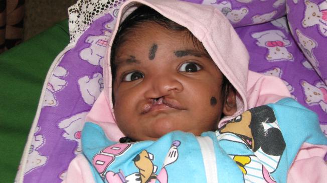 free cleft palate surgery india